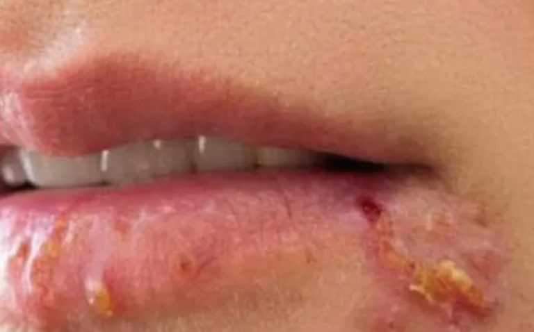 If you see this appearing on your lips, it is a sign of ca….